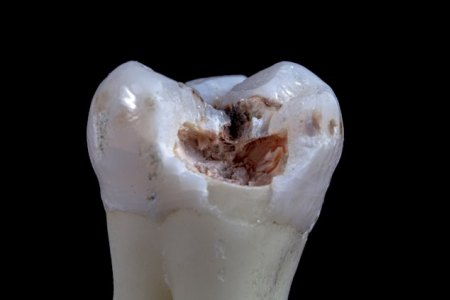 Gangrena