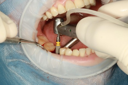Zubni implantati