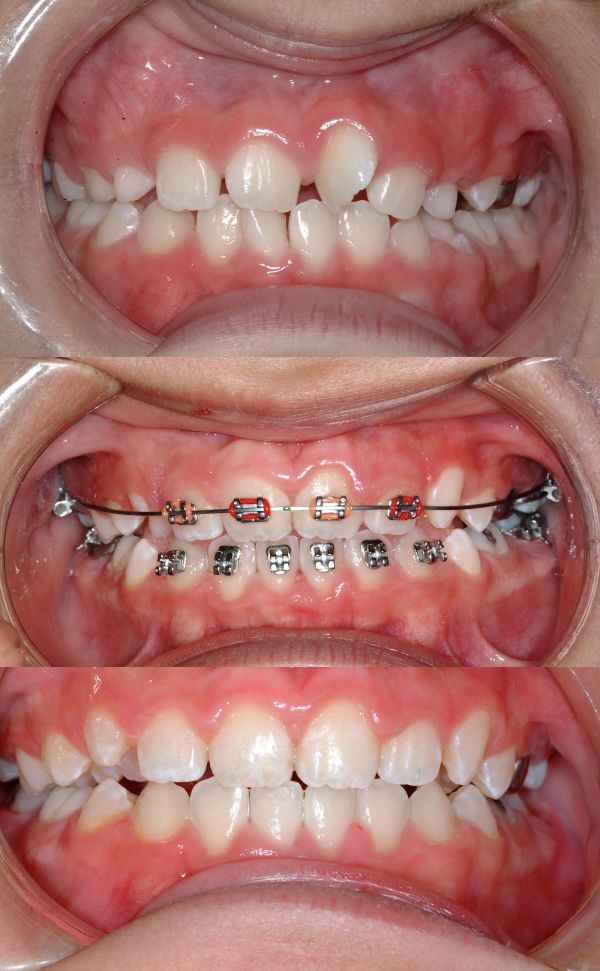 Pre i posle